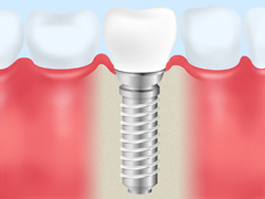 インプラントとは？
